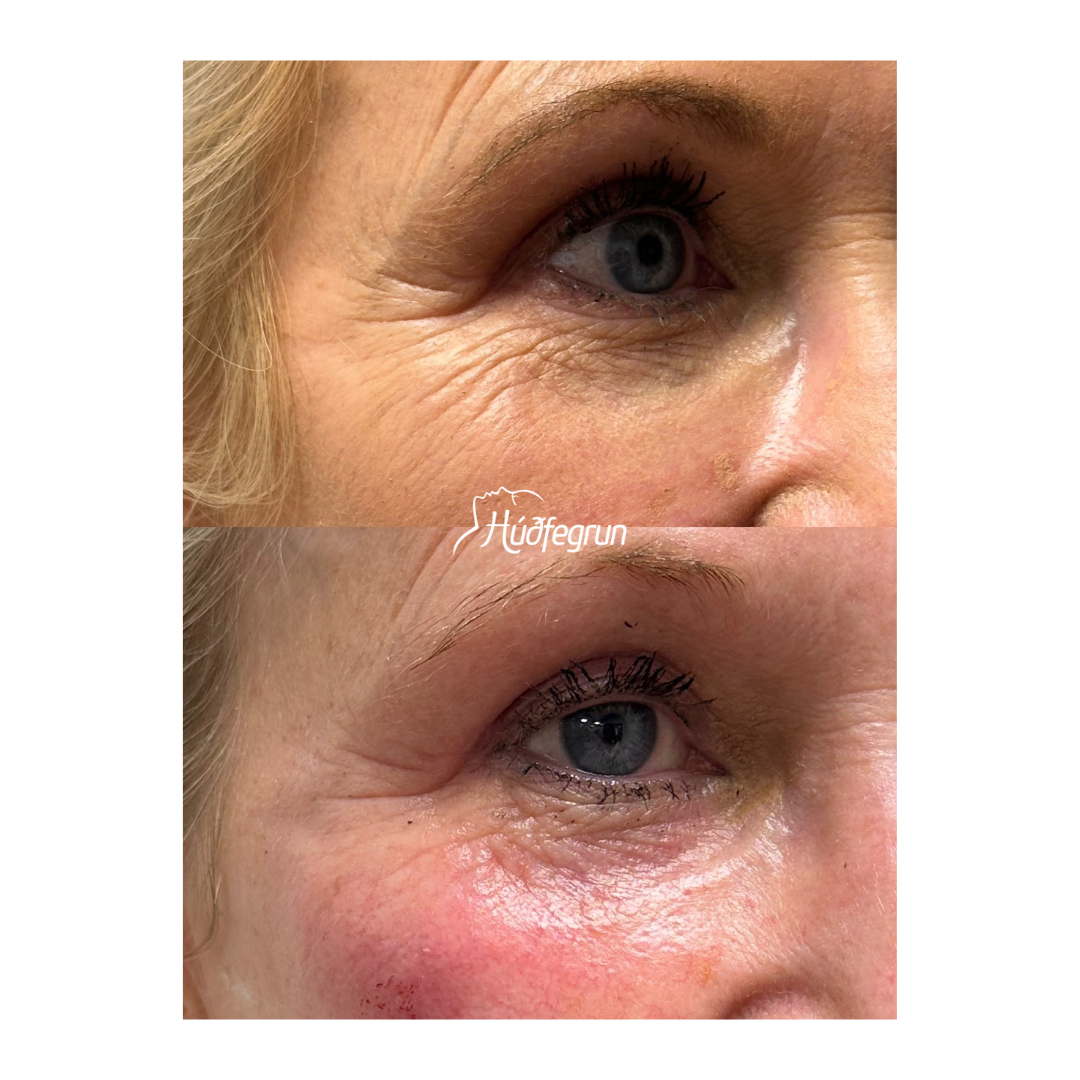 Hyaluronic Acid Booster