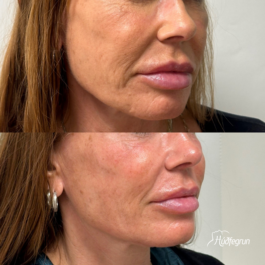 Hyaluronic Acid Booster