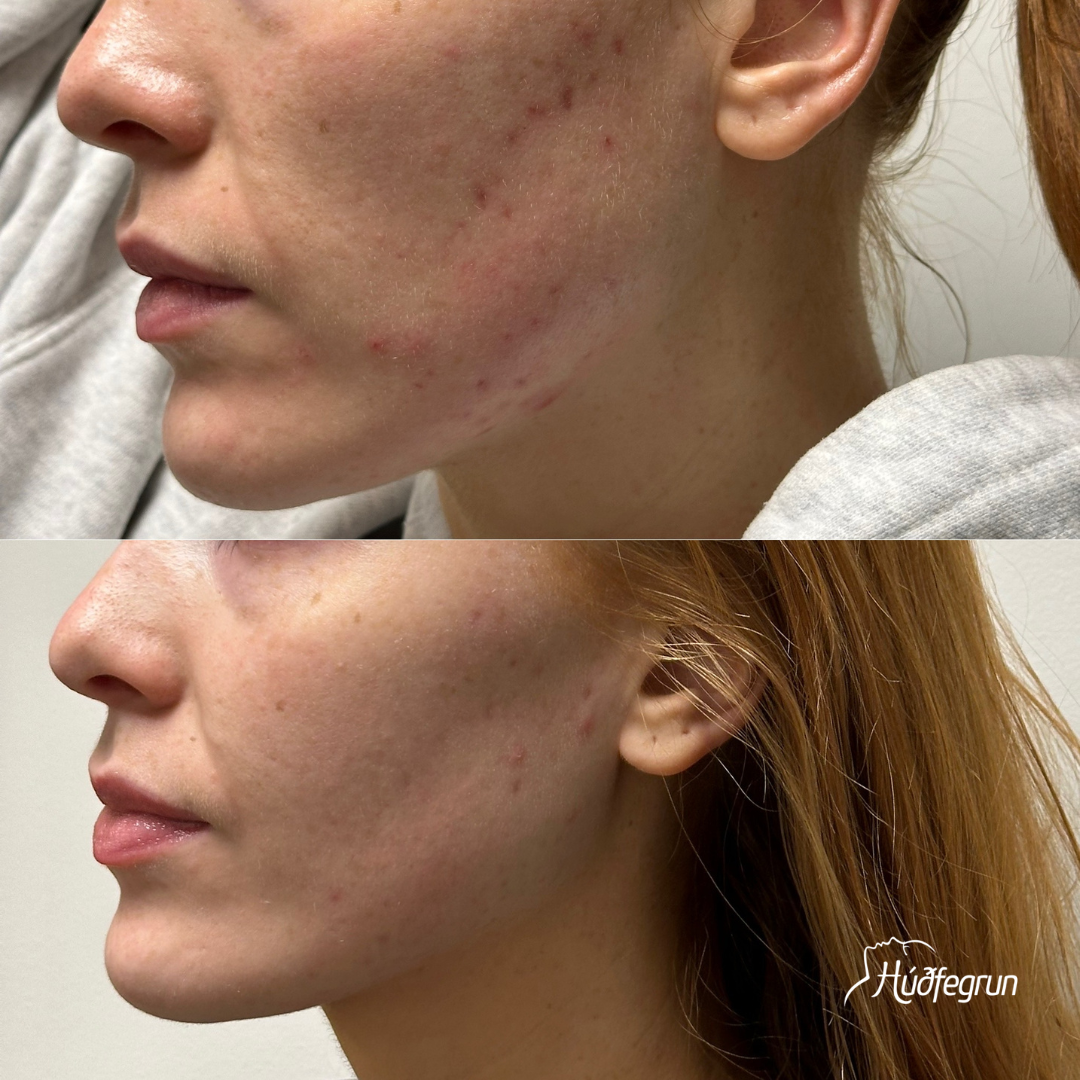 Erbium YAG Laser