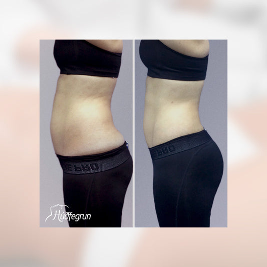 Fitueyðing Ultrasound