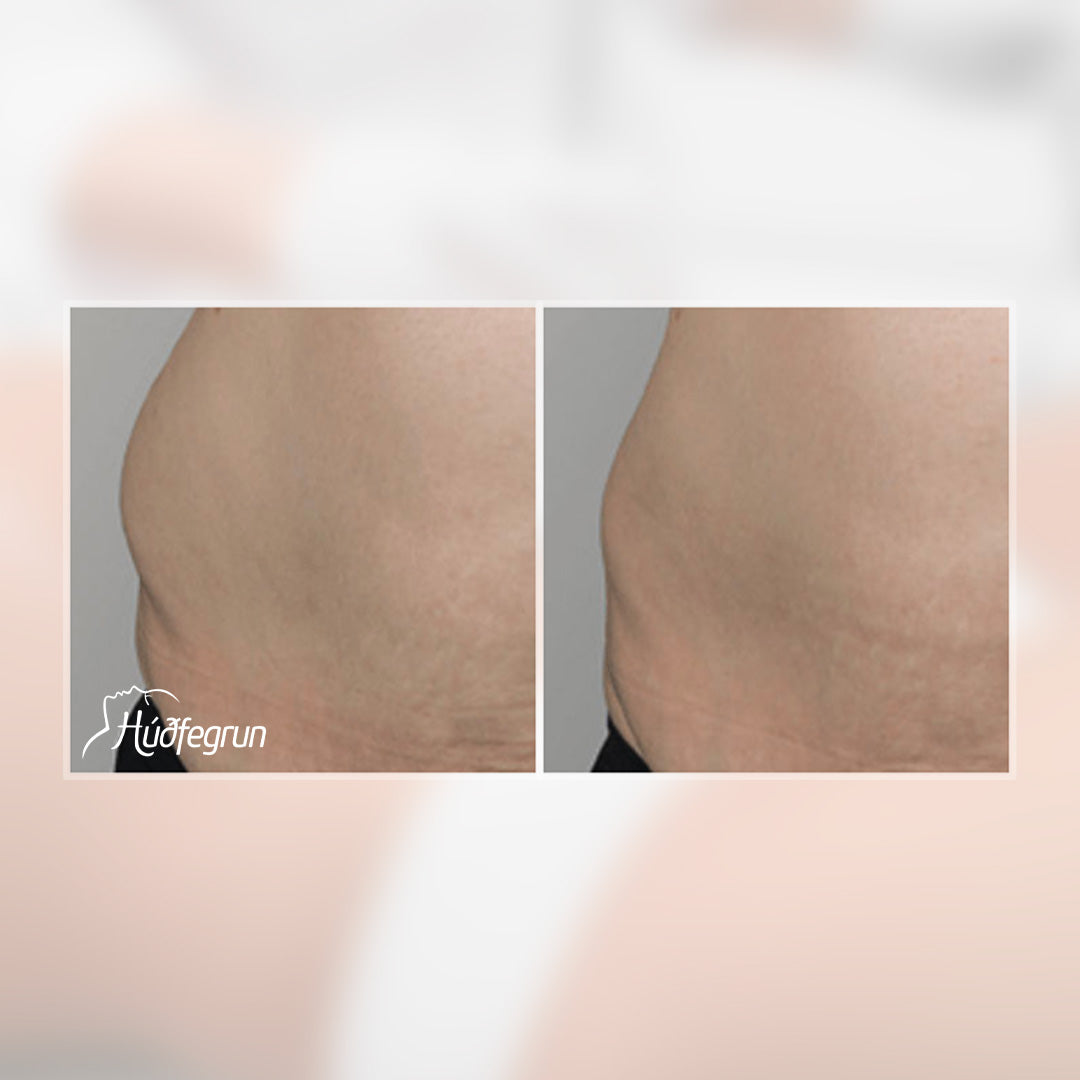 Fitueyðing - Fituleysandi efni