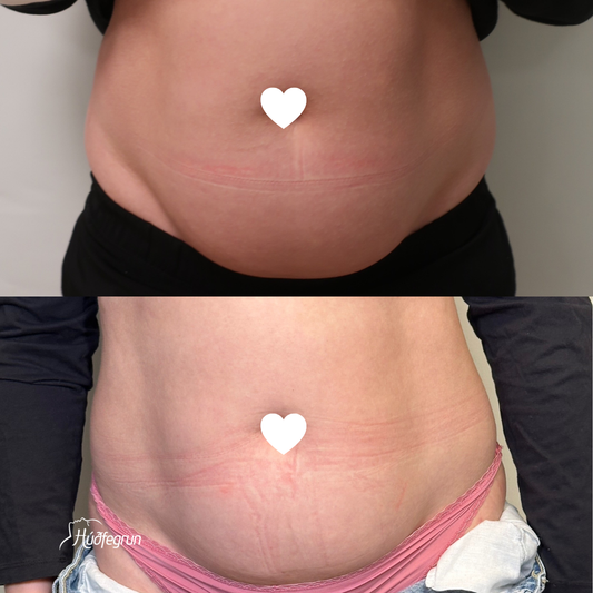 Fitueyðing Ultrasound