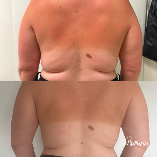 Fitueyðing - Fituleysandi efni