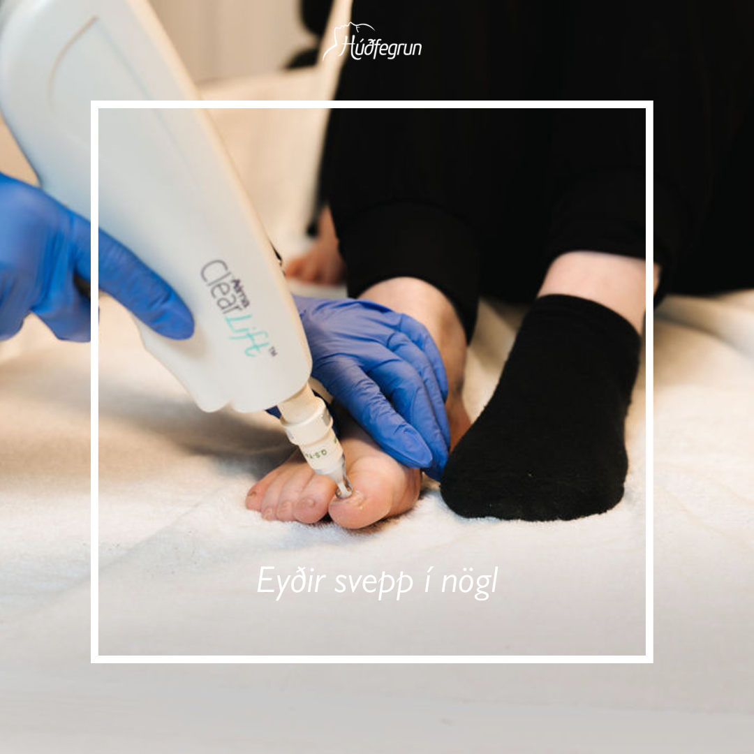 Sveppaeyðing
