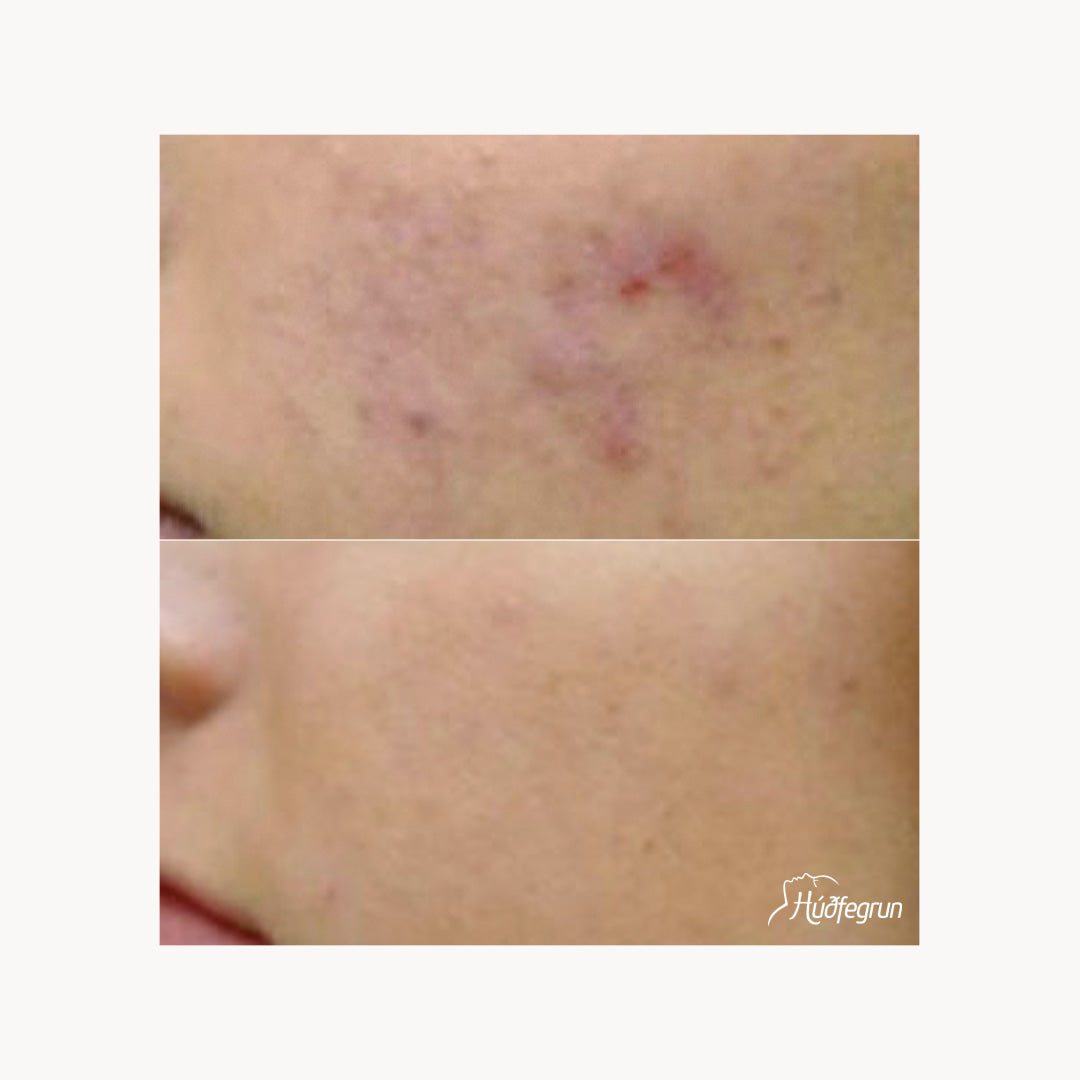 Dermapen