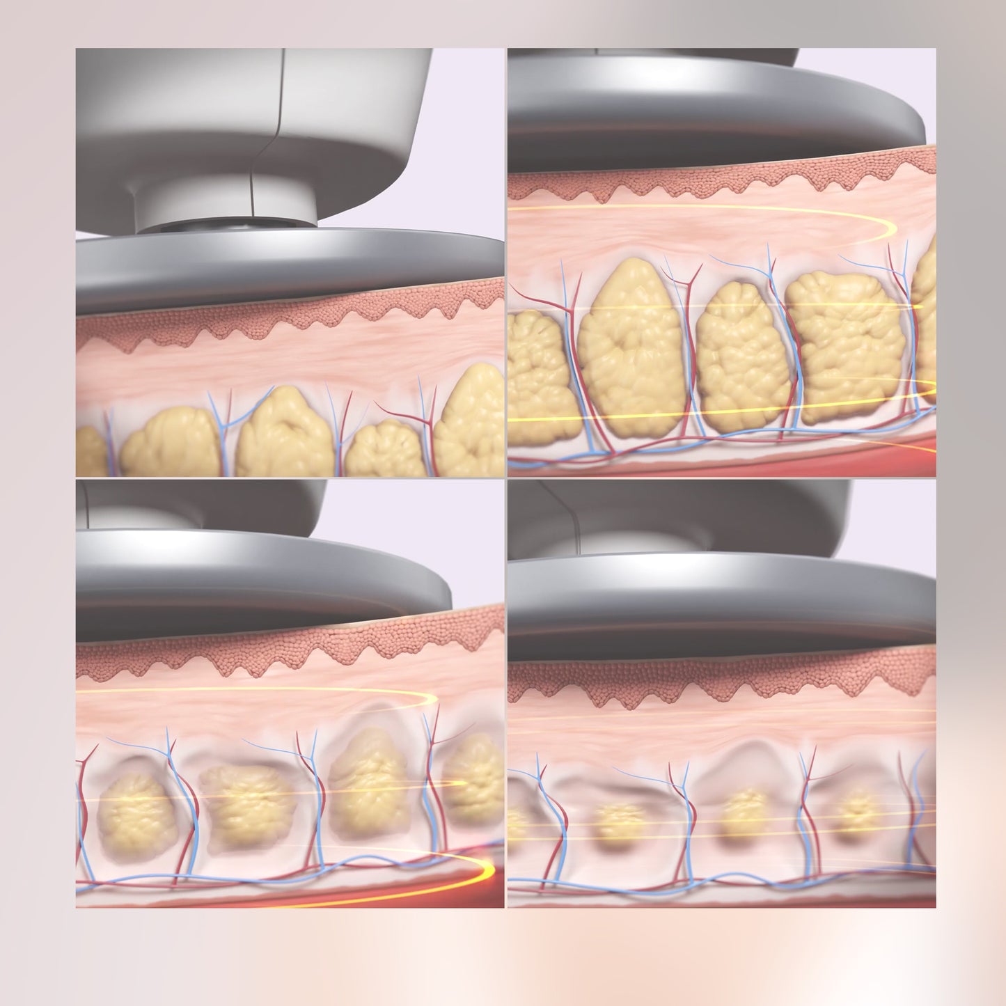 Fitueyðing Ultrasound
