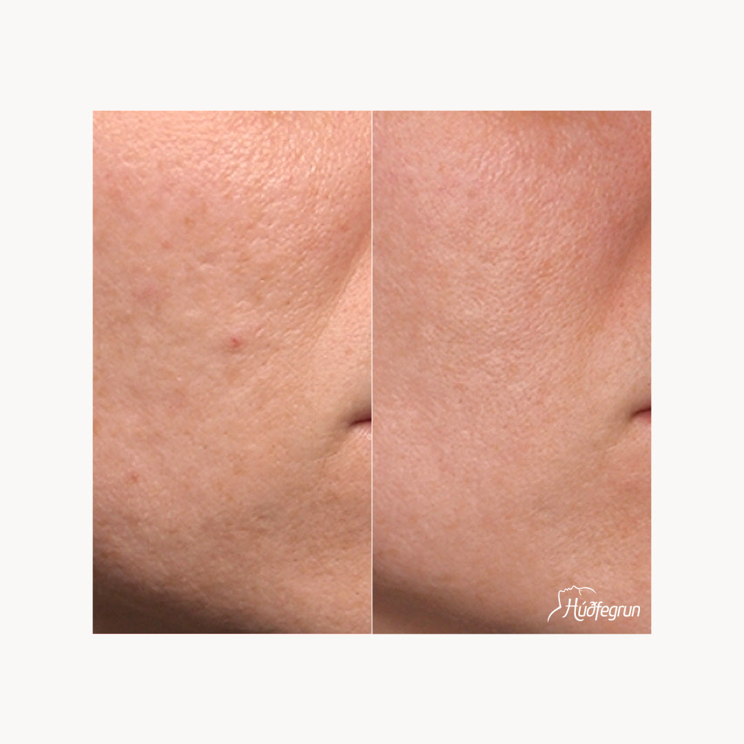 Erbium YAG Laser