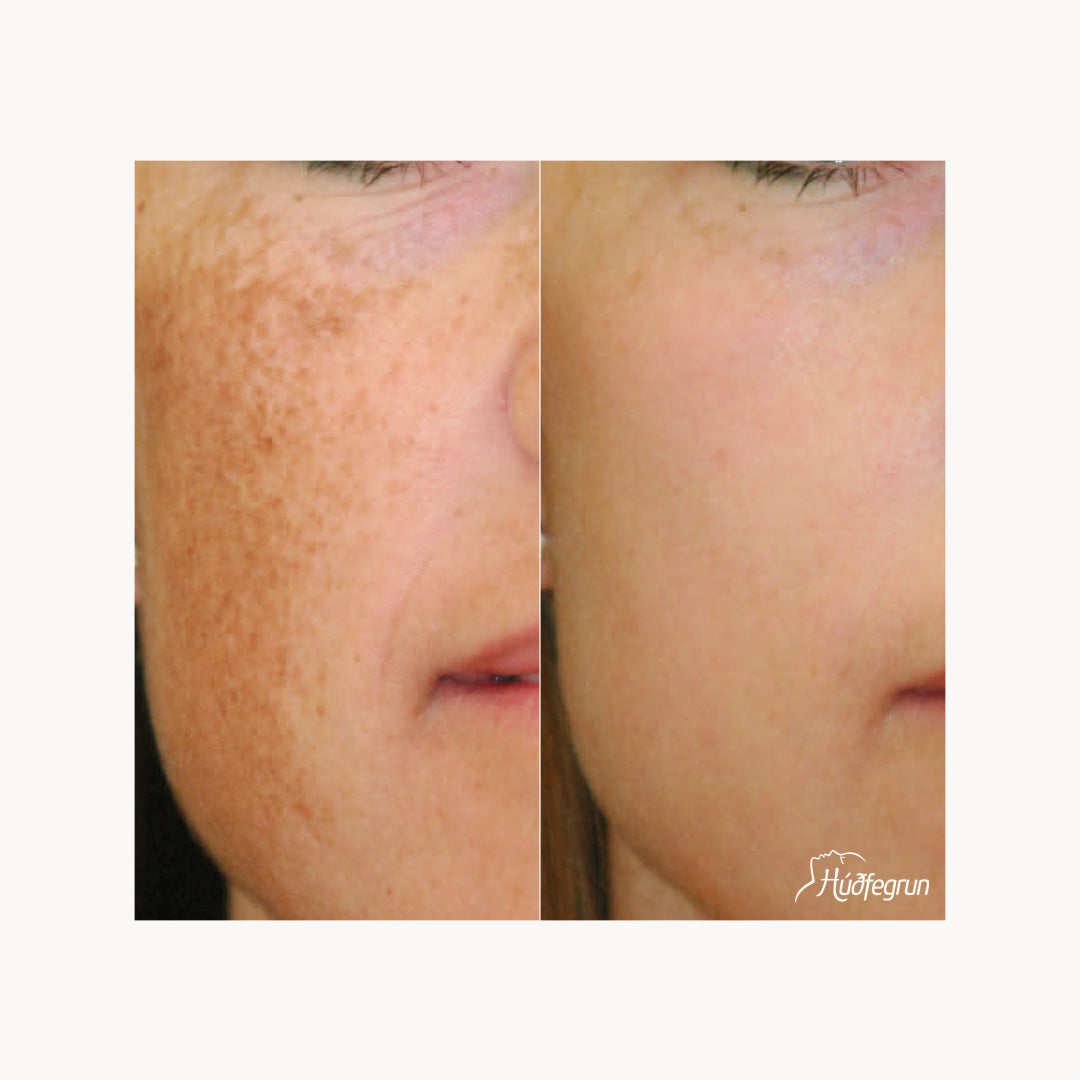 Erbium YAG Laser