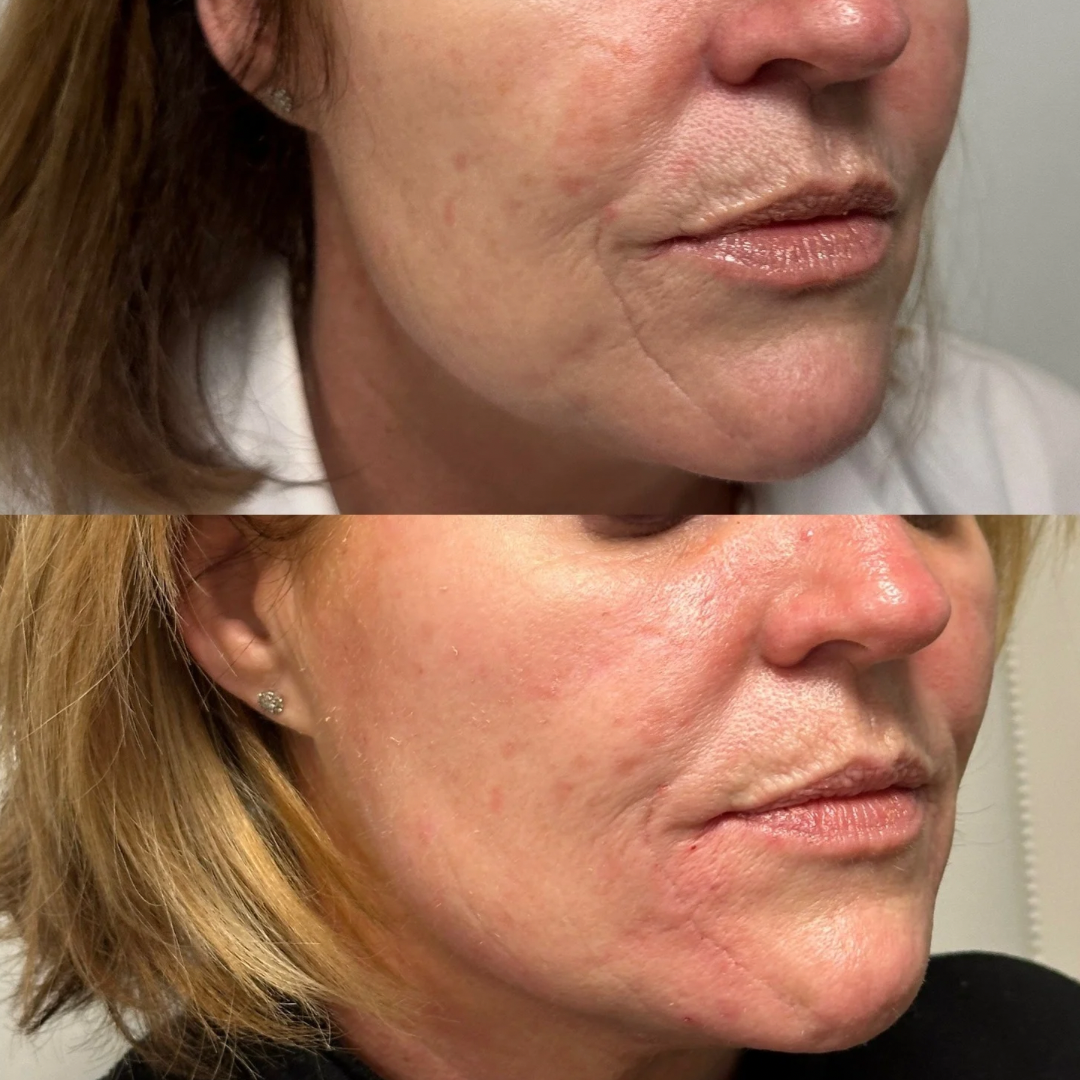 Laserlyfting