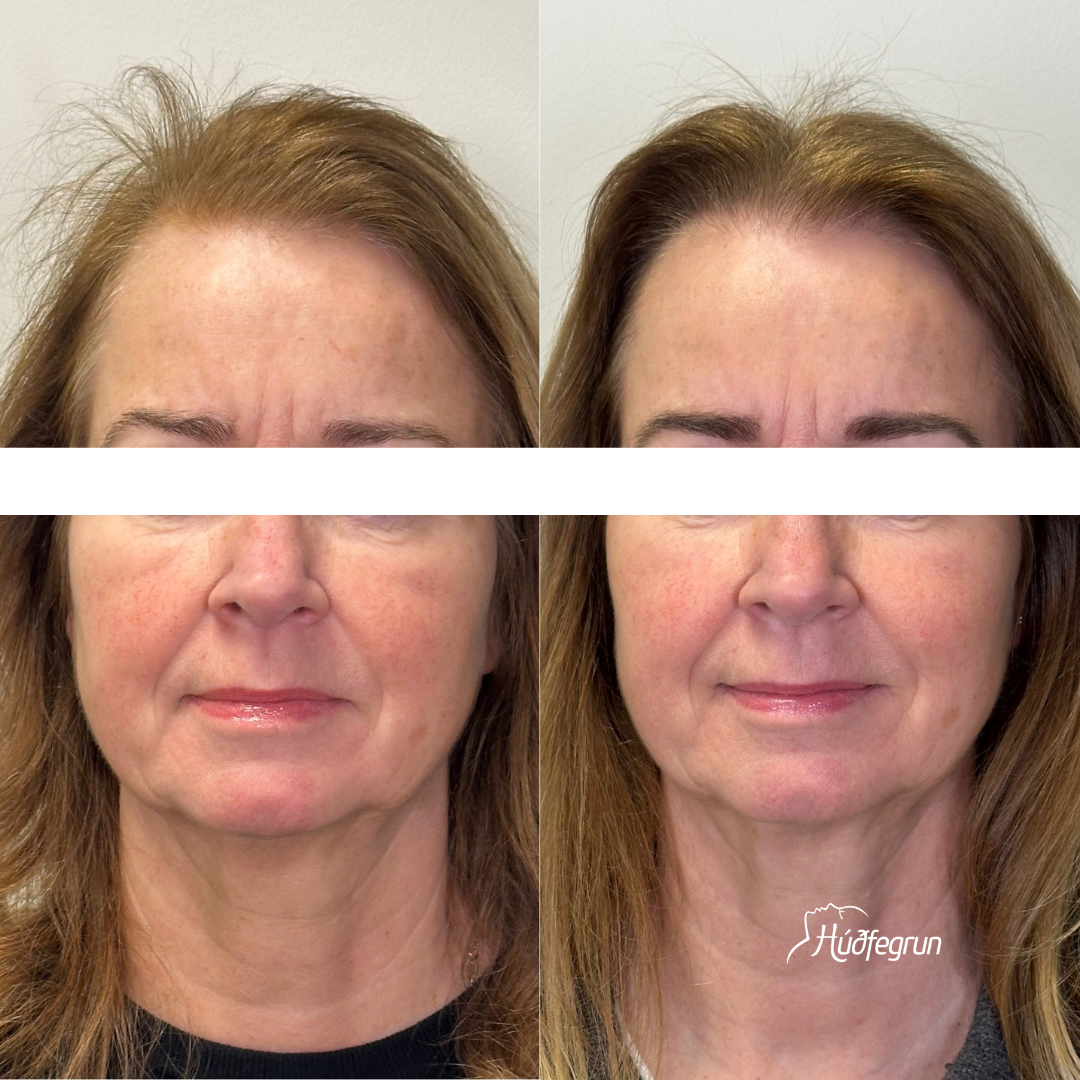 DermaBooster