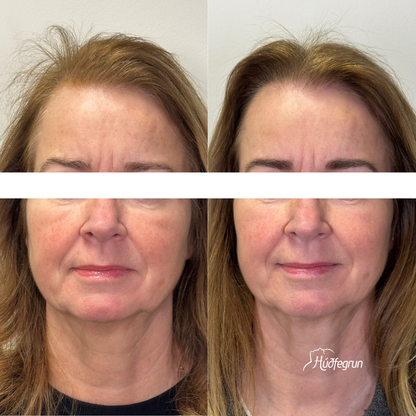 DermaBooster
