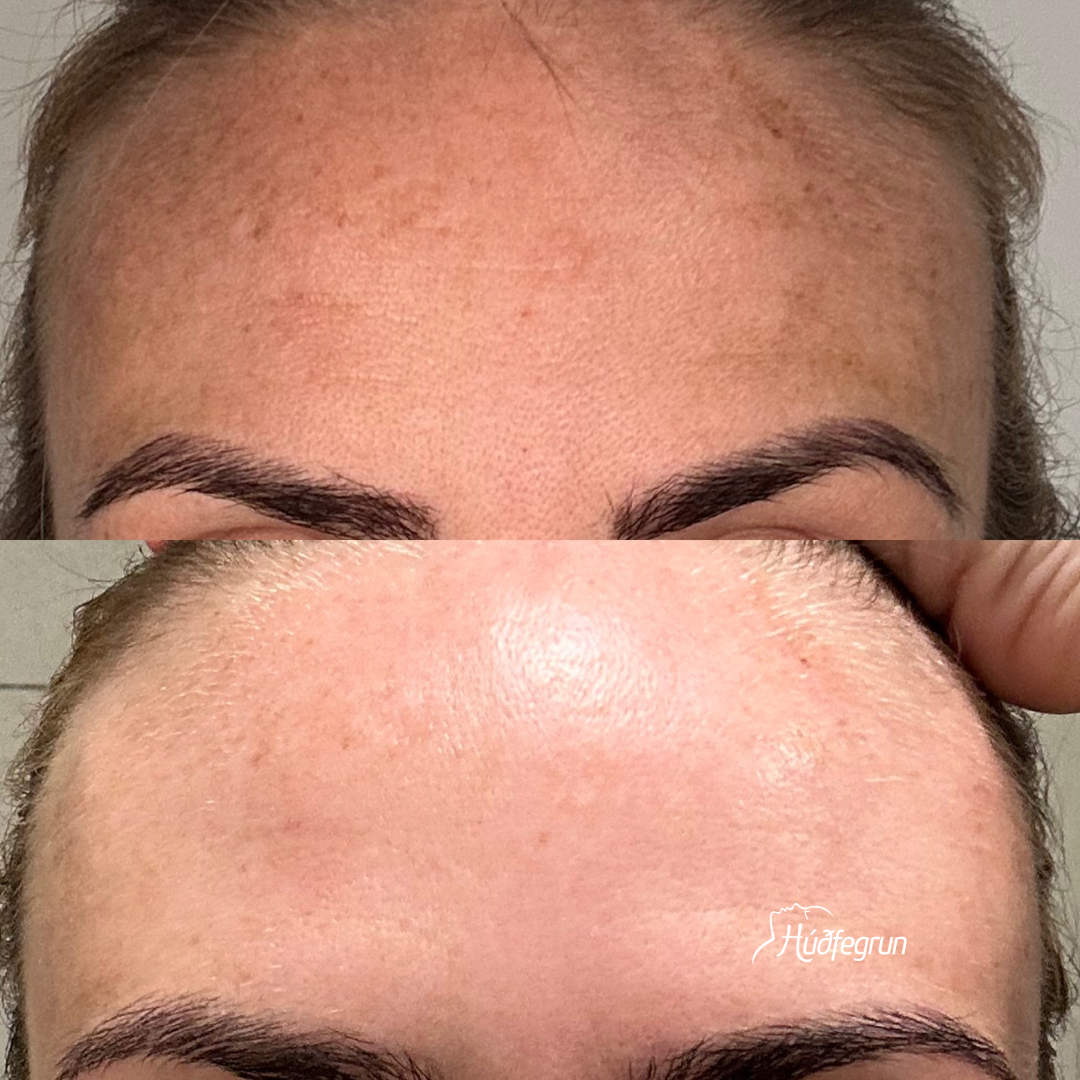 DermaBooster
