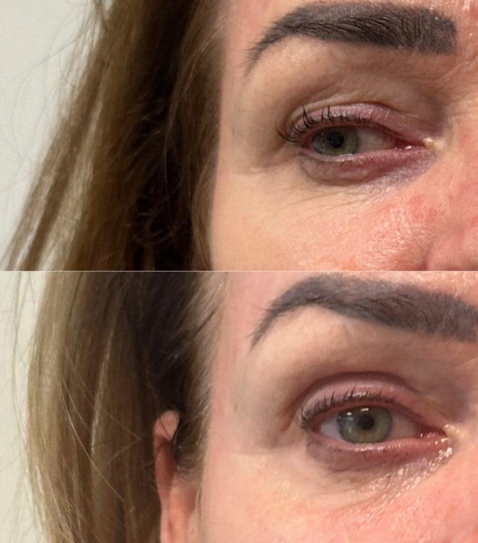 Laserlyfting