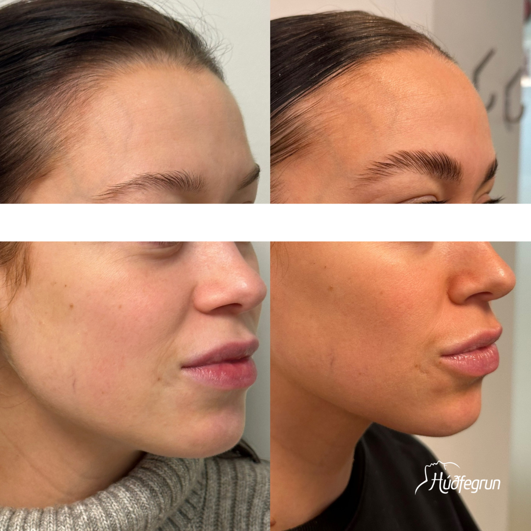 Hyaluronic Acid Booster