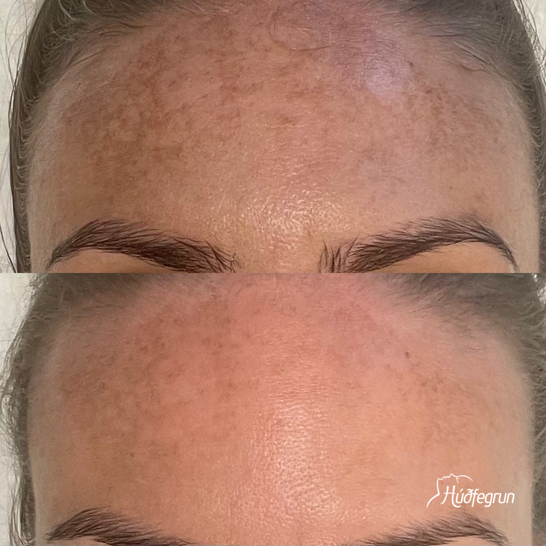 Dermapen