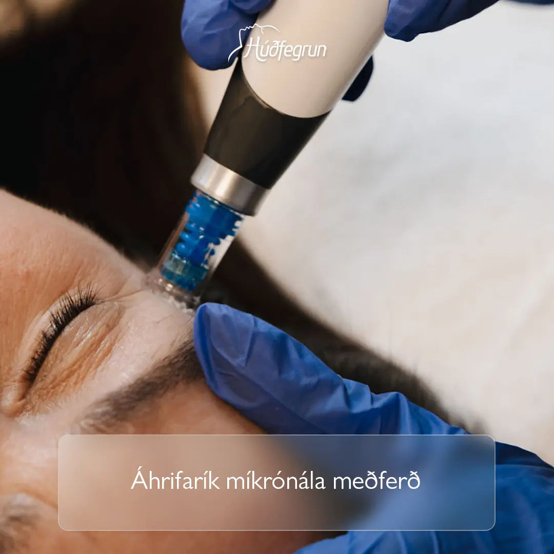 „Dermapen microneedling hjá Húðfegrun, öflug húðmeðferð sem örvar kollagen, styrkir húð og dregur úr hrukkum, línum og örum. Mynd notuð í vefverslun Húðfegrunar til að sýna háþróaða húðmeðferð án skurðaðgerða.“