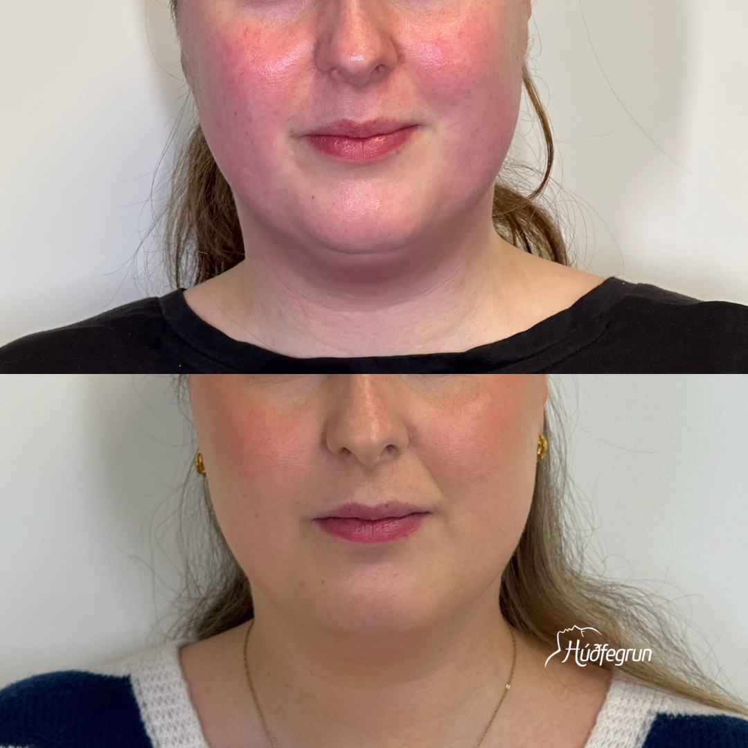 Fitueyðing Ultrasound