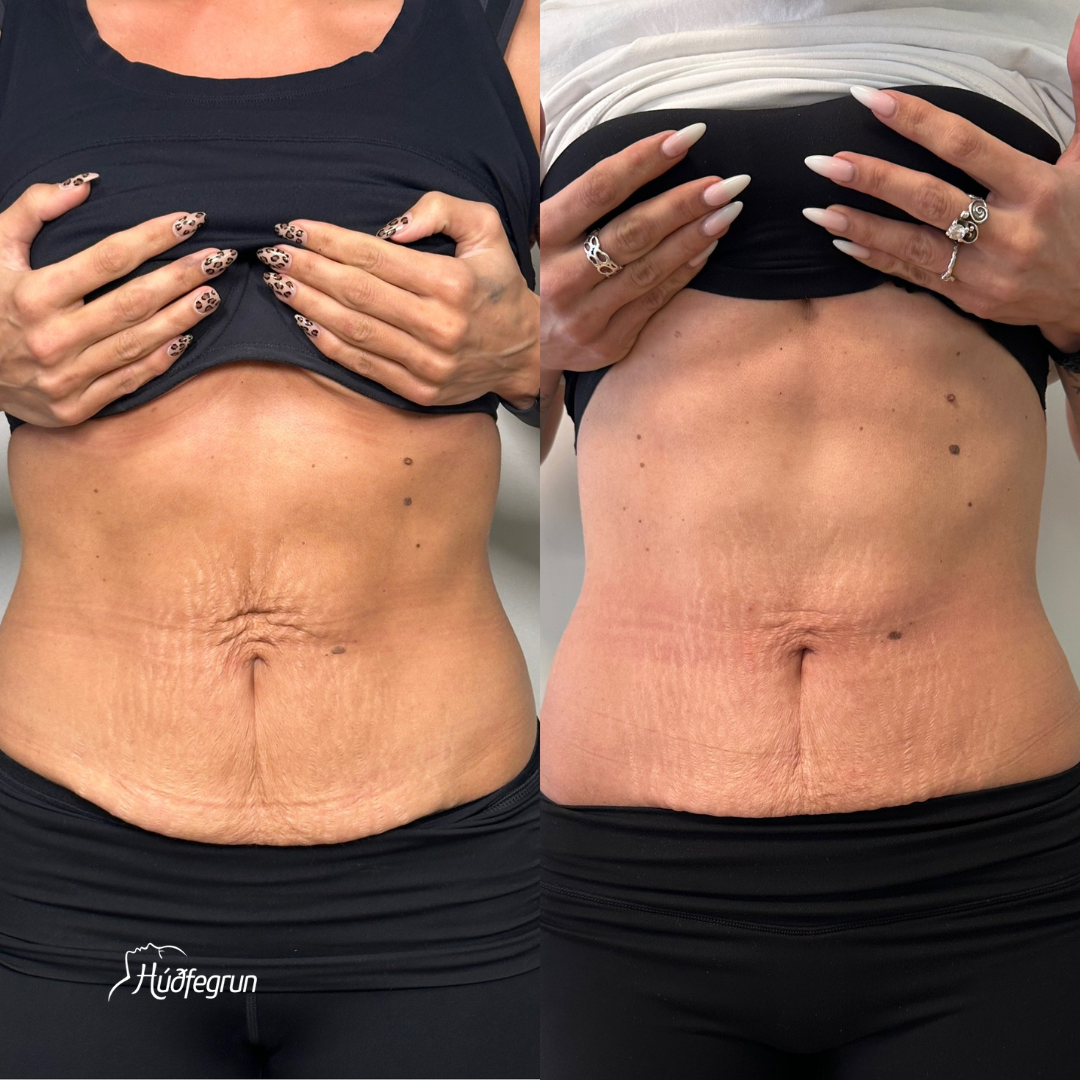 Húðþétting