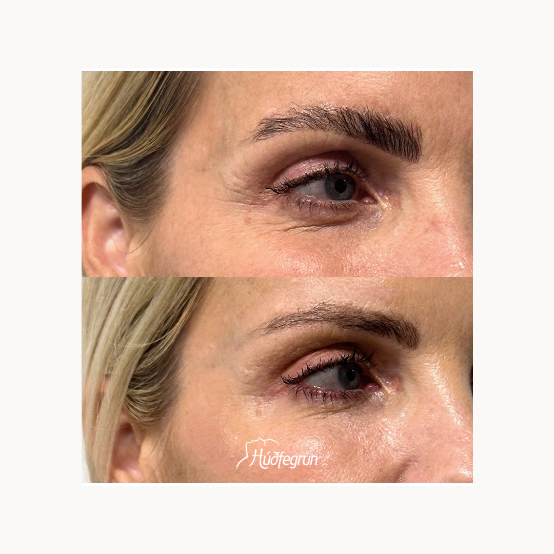 Hyaluronic Acid Booster