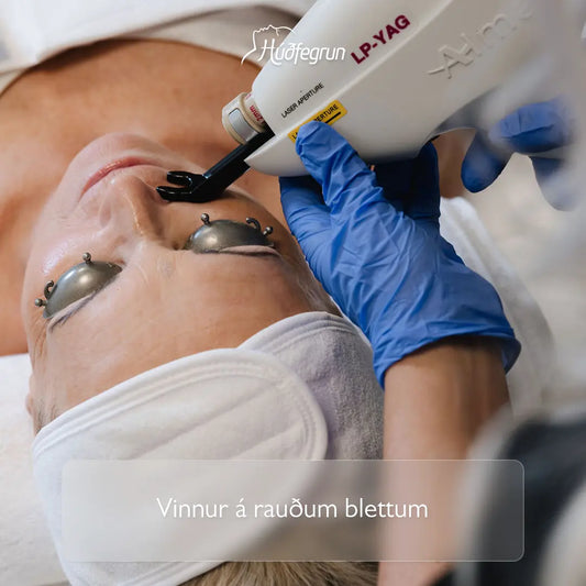 „Lasermeðferð hjá Húðfegrun sem vinnur á grunnum og djúpum háræðaslitum, rósroða og rauðum blettum með öruggri upphitun æðanna án skemmda á húð. Mynd notuð í vefverslun Húðfegrunar til að sýna markvissa æðameðferð.“