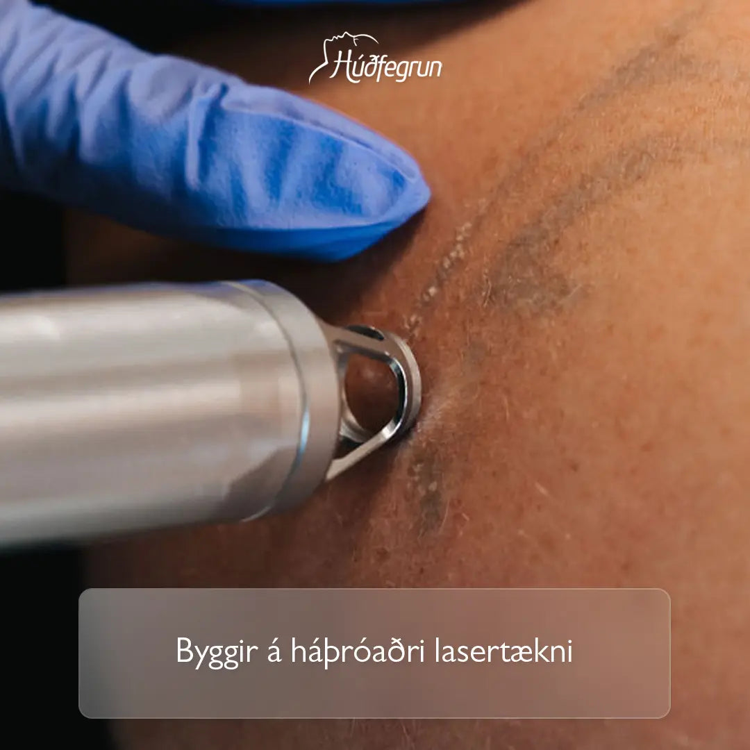 „Lasermeðferð hjá Húðfegrun til að brjóta niður tattoo og litabreytingar í húð með nákvæmri ljósetækni sem skaðar hvorki húð né nærliggjandi vefi. Mynd notuð í vefverslun Húðfegrunar til að sýna örugga og árangursríka tattoo-eyðingu.“