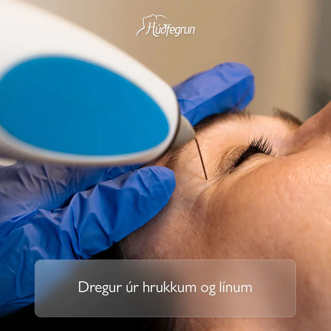 „RF Plasma Hrukkubaninn hjá Húðfegrun, háþróuð meðferð sem dregur úr hrukkum, þéttir húð og örvar kollagen á afmörkuðum svæðum í andliti. Mynd notuð í vefverslun Húðfegrunar til að sýna markvissa og endurnýjandi húðmeðferð.“