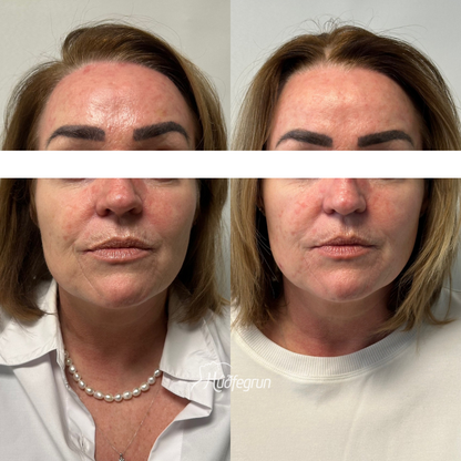 Laserlyfting