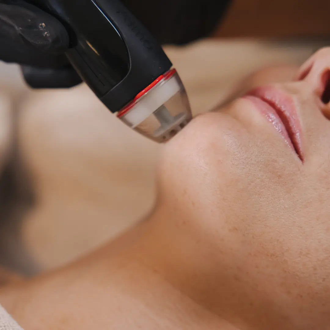 Nærmynd af húð í DermaClear meðferð þar sem hökusvæði er djúphreinsað og nært. DermaClear meðferðin bætir áferð húðar, eykur raka og stuðlar að sléttari og heilbrigðari húð.