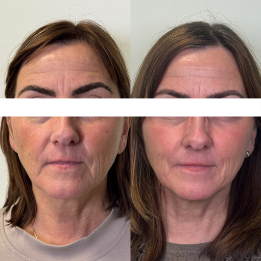 Erbium YAG Laser