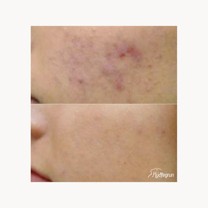Dermapen