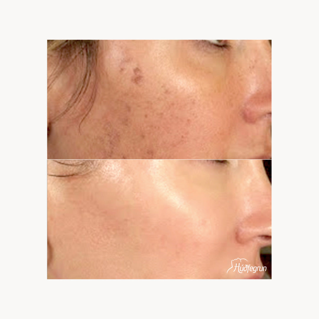 Dermapen
