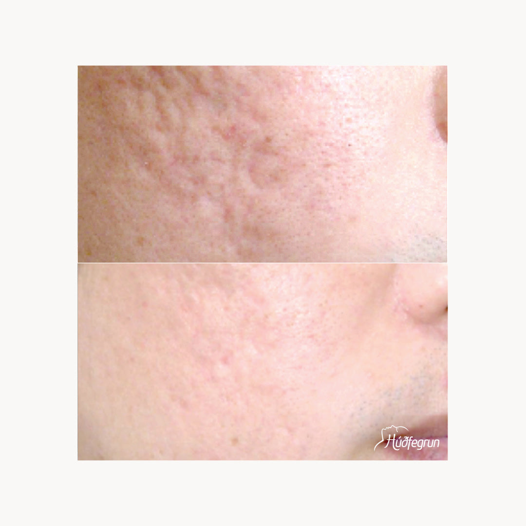 Dermapen