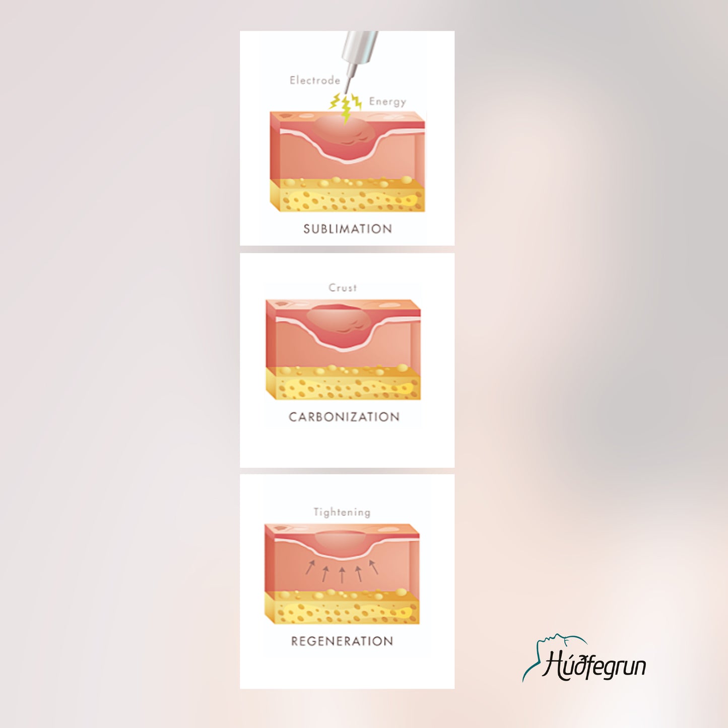Augnlyfting