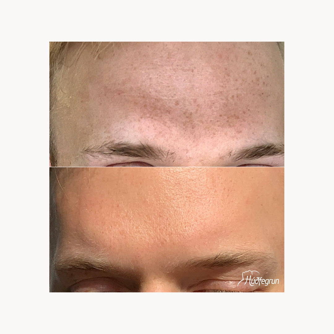 Dermapen