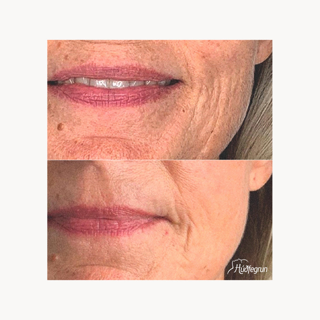 Laserlyfting