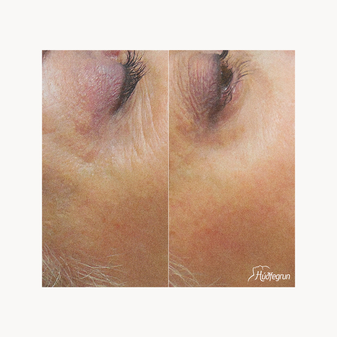 Laserlyfting