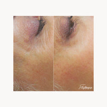Load image into Gallery viewer, Laserlyfting
