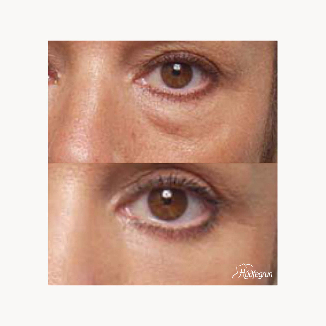 Laserlyfting