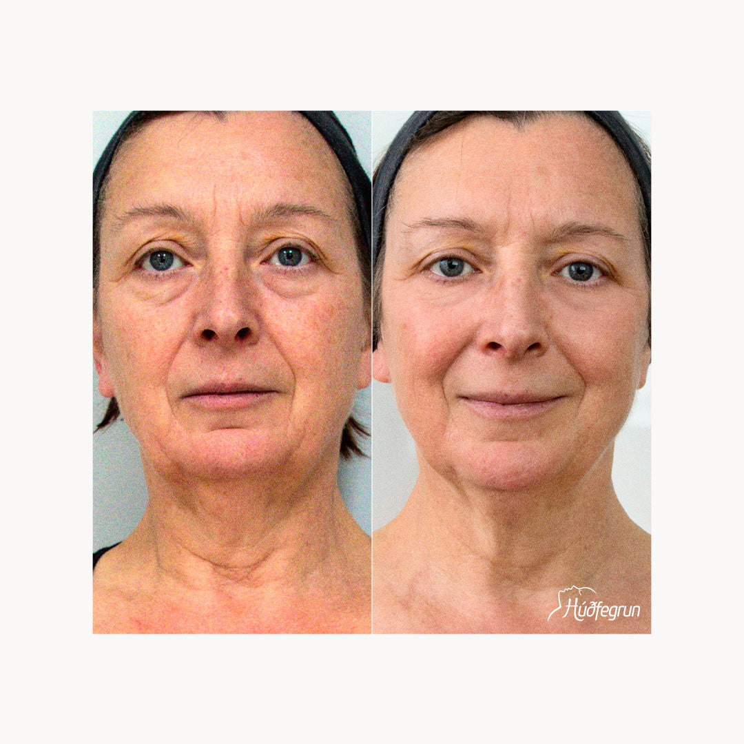 Laserlyfting