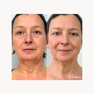 Laserlyfting