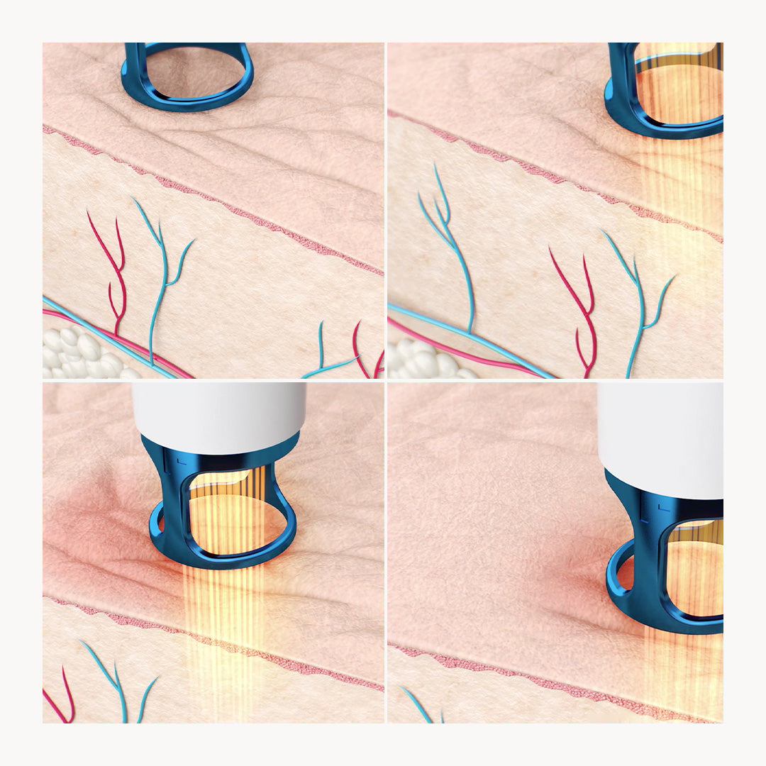 Laserlyfting